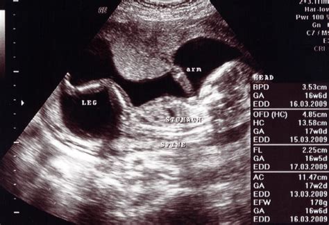 dating ultrasound at 16 weeks